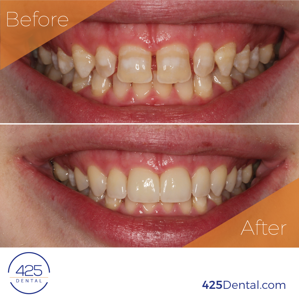 Veneers BA Social Template Ian Veneers