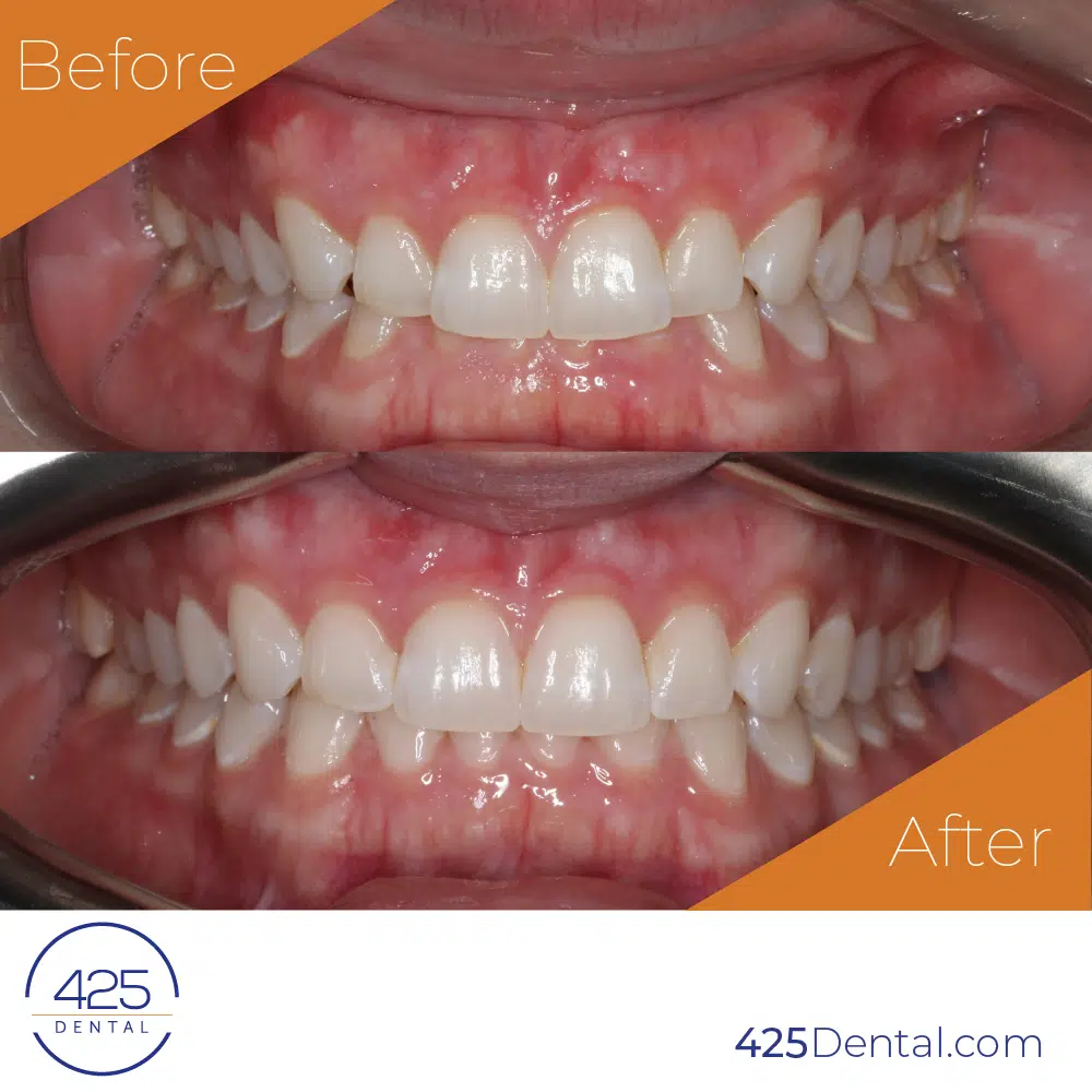 Gaia-425-Dental-Before-After-3_425-Dental-Elsa-W-Insta-1-1-1